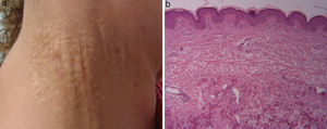 a) Lesiones papulares amarillentas con aspecto de «piel de gallina» en la región cervical derecha, rodeada de piel normal. b) Tinción con hematoxilina-eosina: muestra fibras elásticas calcificadas en la dermis reticular.