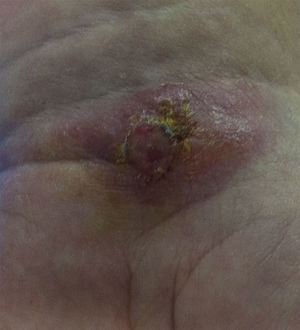 Lesión de leishmaniasis cutánea en carpo (botón de Oriente).