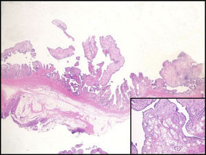 Proliferación vellositaria sinovial. Inset: infiltración adiposa.