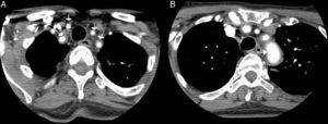 Angio-TAC: se confirma la presencia de un engrosamiento inflamatorio concéntrico/vasculitis de todos los troncos supraórticos (A) y del cayado aórtico (B) (flechas). La mayor afectación parece de la arteria subclavia izquierda, sin que se demuestren estenosis significativas a ningún nivel. En territorio carotídeo solo parece afectarse las carótidas comunes, sin extensión a ACI.