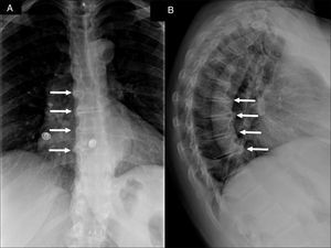 Radiografías de LA columna dorsal anteroposterior (A) y lateral (B) en las que se observan puentes óseos en la cara anterolateral derecha de 4 cuerpos vertebrales contiguos (flechas blancas) compatibles con el diagnóstico de HEID. En la radiografía lateral se aprecia, además, que dichos puentes óseos forman ángulos de más de 45° con el borde vertebral.
