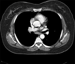 Torax CT showed bilateral multiple mediastinal and hilar lymphadenopathy.