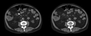 TC abdominal: Adenopatías inferiores a 9mm, inespecíficas, situadas en el eje mesentérico.