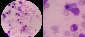 Aspiración de médula ósea. La citopatología de este tejido muestra hemofagocitosis activa por parte de las células macrofágicas (tinción hematoxilina-eosina, ×1.000).