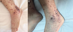 Forma vesiculoampollosa de vasculitis leucocitoclástica cutánea. A) Antes del tratamiento antibiótico. B) Después del tratamiento antibiótico.