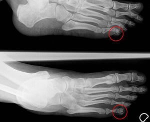 En la radiografía simple se observa una pequeña calcificación en zona lateral de la quinta falange distal.