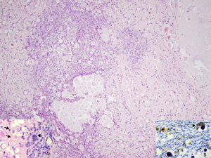 Abundantes cuerpos de psamoma, y proliferación de células mononucleares de hábito fusocelular (H&E ×100). A) Presencia de calcificaciones esféricas (flechas) y células gigantes multinucleares (cabeza de flecha) (H&E ×200). B) La inmunotinción con CD68 revela la presencia de células mononucleares dispersas, y rodeando las calcificaciones y células gigantes multinucleadas (cabeza de flecha) (CD68×200).