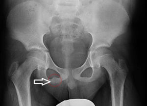 Radiografía AP de pelvis: engrosamiento de la sincrondrosis isquiopubiana derecha.