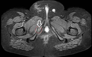 RM de pelvis de corte axial (STIR): engrosamiento de la sincondrosis isquiopubiana derecha con bordes irregulares. Alteración de la señal de médula ósea y edema de partes blandas circundantes.