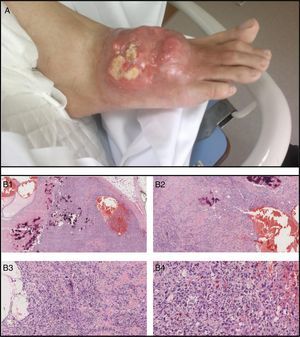 Osteosarcoma en dorso de pie derecho, en paciente con gota tofácea. A) Descripción macroscópica: placa de aspecto tumoral eritemato-violácea infiltrada de 6cm de diámetro máximo, compuesta de nódulos tumorales duros, de consistencia ósea, petrificados, y en superficie lesiones tumorales excrecentes y de base ligeramente pediculada de unos 3cm de diámetro. B) Descripción microscópica (hematoxilina eosina [HE]; de izquierda a derecha y de arriba a abajo: B1: H&E ×2; B2: H&E ×4; B3: H&E ×10; B4: H&E ×20). Osteosarcoma de alto grado, de tipo telangiectásico, con abundante formación de osteoide y espacios llenos de sangre sin revestimiento epitelial. A gran aumento se observan células de talla grande, con núcleos irregulares y pleomórficos, reconociéndose numerosas mitosis, muchas de ellas atípicas.