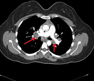 Thorax computed tomography shows bilateral hilar and mediastinal lymphadenopaties.