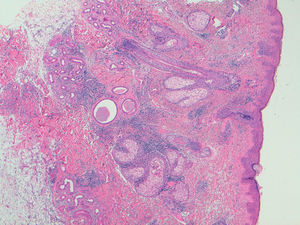 Imagen histológica de la biopsia cutánea. Se observa infiltrado linfohistiocitario intersticial en dermis superficial y profunda, con presencia de depósitos de mucina dispuestos alrededor de fibras de colágeno, correspondiendo histopatológicamente a una dermatitis intersticial granulomatosa.