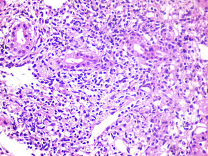 Necrosis en sacabocado con daño al hepatocito. Lesión necro inflamatoria.