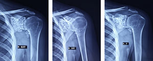Las radiografías de hombro en posiciones AP verdadera, rotación externa y rotación interna demuestran la presencia de múltiples cuerpos calcificados de tamaño uniforme, distribuidas en toda la articulación glenohumeral izquierda, así como en el receso subescapular y el canal del tendón bicipital.