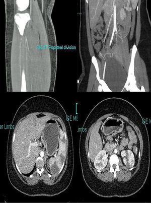 Extensive fresh thrombus is noted in the left inflow, left CFA and the left SFA. Thrombus also noted in the right internal iliac, right profunda and SFA origin. Fresh thrombus noted in the right distal popliteal and trifurcation origin. Multiple splenic and left renal infarcts noted.