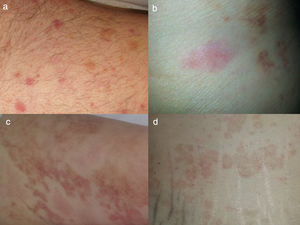 Urticaria con vasculitis. Los 4 pacientes tienen biopsia que confirma la vasculitis leucocitoclástica. Nótese la presencia de lesiones urticariformes agudas y lesiones en resolución con púrpura (a-d).
