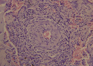 Estudio histopatológico de biopsia del pulmón, con vasculitis de vasos pequeños, con extensas áreas de fibrosis y enfisema pulmonar.