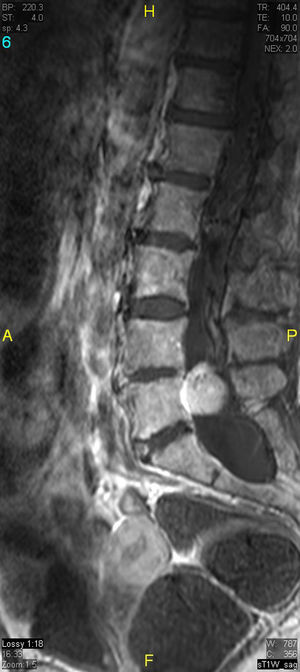 Corte sagital T1 TSE con contraste. Intenso realce de la masa intradural.