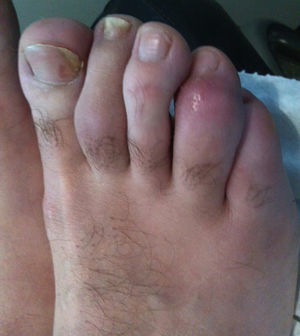 Dactilitis 4.° dedo.