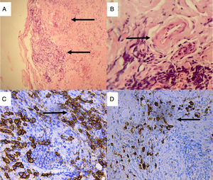 Biopsia de glándula lacrimal. Tinción hematoxilina-eosina: A) Fibrosis estoriforme y esclerosis estromal, infiltrado inflamatorio crónico (×10); B) Venas con paredes engrosadas con infiltración de sus paredes por células inflamatorias mononucleares causando obliteración de la luz. Tinción de inmunohistoquímica (×40). C) Extenso infiltrado de plasmocitos que expresan CD38 (×40 tinción DAB anti-CD38); D) Plasmocitos que expresan IgG4 (×40 tinción DAB anti-IgG4).