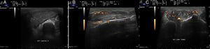 A) Imagen del compartimento dorsal de la muñeca derecha. Distorsión de la arquitectura de los compartimentos extensores. Presencia de una gran masa de partes blandas que deforma el recorrido de los extensores comunes, del extensor del quinto dedo y del extensor cubital. B) Imagen en corte longitudinal, y C) Transversal del tendón extensor común de los dedos a nivel de la muñeca. Incremento de neo-vascularización con señal color Doppler evidente (G3) de actividad sobre el tendón extensor e infiltración de material infeccioso alrededor.