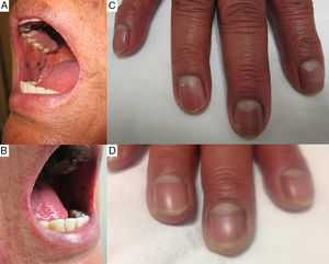 A y B) Presencia de manchas hiperpigmentadas a nivel de la mucosa yugal y del labio inferior, de bordes bien definidos. C) Presencia de bandas hiperpigmentadas de color marrón a nivel ungueal. D) Disminución en la intensidad de la pigmentación a nivel ungueal (sin desaparecer por completo) a los 3 años de suspensión de la cloroquina.