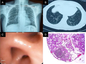A) Rx de tórax PA. Imágenes compatibles con patrón reticulonodular bilateral, predominantemente basal, con tamaño pulmonar conservado. B) TACAR de tórax con imágenes en anillo de sello en ambos pulmones, nódulos centrilobulillares y patrón en árbol en gemación. C) Bronquio del lóbulo inferior derecho con edema y disminución concéntrica de los orificios de la pirámide basal. D) Biopsia de glándula salival. Infiltrado inflamatorio de predominio linfocítico, con formación de 2 agregados linfoides de más de 50 células/mm2.