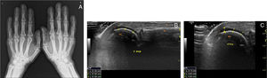 (A) PA conventional X-ray of hands showing diffuse soft tissue hypertrophy, acral enlargement and joint space widening. (B and C) Ultrasound longitudinal image of the second and fourth MCP joints in maximal flexion shows increased anechogenic cartilage thickness (normal 0.02–0.05cm).2 Mcp, metacarpophalangeal joints; mc, metacarpal head; P, proximal phalanx base; T, extensor tendon; * cartilage.