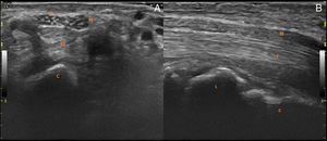 Ultrasound transverse (A) and longitudinal (B) image of the enlarged fascicular pattern of median nerve of right hand, area: 22mm2 (normal less than 12mm2).3 Power Doppler signal was absent. C, capitate; FT, flexor tendons; M, median nerve; R, flexor retinaculum; L, lunate.