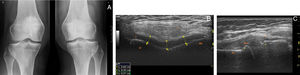 (A) PA conventional standing knees X-ray showing joint space widening. (B) Transverse ultrasound image of the knee cartilage in maximal flexion illustrates increased anechogenic cartilage (normal 0.25–0.3cm).4 (C) Longitudinal ultrasound image of medial compartment of the right knee depicts small hyperechogenic articular femoral and tibial bony margins set-ups that represents osteophytes, poorly visualized in the X-ray. C, cartilage; LC, lateral condyle; MC, medial condyle; F, suprapatellar fat pad; Fe, femur; T, tibia; Mm, medial meniscus; L, Medial collateral ligament; * osteophytes.