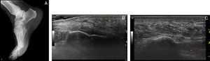 (A) Lateral right foot X-ray showing increased heel fat pad. (B) Longitudinal ultrasound image showing homogeneous Aquiles tendon and enthesis. (C) Longitudinal ultrasound image of plantar fascia insertion that shows homogeneous non thickened fascia and increased fat pad: 1.4cm (normal <0.39mm).5 F, Kager