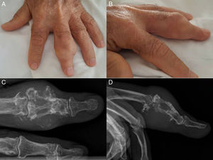 A y B) Tumoración multilobulada en la segunda falange del tercer dedo de la mano izquierda. C y D) Radiografía PA y lateral del tercer dedo de la mano izquierda; se visualiza una lesión lítica expansiva de gran tamaño, que insufla, adelgaza y destruye la cortical.