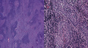 Biopsy of extranodal marginal zone lymphoma of mucosa-associated lymphoid tissue of the parotid gland in case 2. Left image shows Hematoxylin & Eosin (H&E) stain in low-power view. Right image shows H&E stain in high-power view.