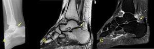 Lateral right ankle radiography (A), T1 weighted sequence (B) and sagittal STIR MRI sequence (C) images demonstrating an enlarged Stieda