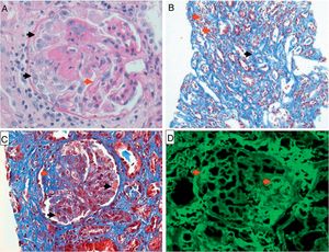 Biopsia renal. A) Coloración de hematoxilina eosina 40×; se observa patrón membranoproliferativo con imagen de doble contorno (flecha roja), formación de semilunas (flechas negras). B) Coloración tricrómica de Masson 10×; se observa nefritis tubulointersticial con infiltrado mononuclear (flechas rojas), fibrosis intersticial (flecha negra). C) Coloración tricrómica de Masson 40×; con presencia de trombos y necrosis fibrinoide en asas capilares (flechas negras), fibrosis glomerular segmentaria (flecha roja). D) Inmunofluorescencia 40×; positiva para inmunoglobulina G con patrón granular focal y solo algunos segmentos de asas capilares (flechas rojas).