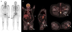 A) Gammagrafía ósea de cuerpo completo con 99mTc-hidroxi-metilen-difosfato en proyecciones anterior y posterior en las que se observa un incremento patológico e irregular de la actividad osteoblástica en el tercio medio y proximal de muslo izquierdo, con captación del trazador en tejidos blandos adyacentes y alteración en la morfología ósea normal (flechas). B) Planos coronal, sagital y axiales de estudio 18F-FDG PET/CT en el que se observan múltiples acúmulos patológicos del radiotrazador que se distribuyen desde planos postero-inferiores de la nalga izquierda hasta tercio medio del muslo ipsolateral (flechas).
