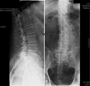 Radiografía AP y lateral de la columna lumbar. Objetivamos dilatación aneurismática de la aorta abdominal marcada con una línea que mide su eje transverso.