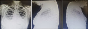 Mujer de 22 años con LEG de 3 años de evolución caracterizado por manifestaciones cutáneas y musculoesqueléticas. Acude por cuadro de un mes de evolución caracterizado por dolor de tipo pleurítico y disnea. La radiografía de tórax simple reveló imágenes radiopacas que obliteran ángulos costodiafragmáticos compatibles con derrame pleural el cual fue abordado y posteriormente atribuido a actividad de su enfermedad de base.
