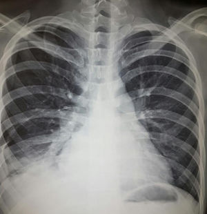 Hombre de 22 años con hermano gemelo con lupus eritematoso sistémico, ambos con datos de síndrome de Schnitzler (cuadros intermitentes de fiebre, urticaria, dolor abdominal, angioedema, artritis), en los últimos 2 meses con disnea progresiva hasta la de mínimos, poliartritis, hipertensión, edema mecánico y en los días precedentes tos e incremento de disnea. A la exploración, con complejo de la pulmonar de Chávez y síndrome de condensación basal derecho; radiografía con datos de hipertensión pulmonar, 4 arcos, neumonitis basal derecha y derrame homolateral. Se realizó diagnóstico de neumonitis lúpica que se manejó con prednisona 0,5mg/kg/día y ciclofosfamida con adecuada respuesta.