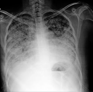 Mujer de 20 años con historia de lupus eritematoso sistémico de 4 años de evolución. Con vasculitis necrosante en miembros inferiores, psicosis, eritema, fotosensibilidad, trombocitopenia, linfopenia, anemia grave, VDRL+ y AAN 1:640 homogéneo y periférico. Últimos meses con disnea progresiva hasta la de mínimos; últimos días con incremento de tos, disnea y hemoptisis; hemoglobina 3g, hipoxemia, proteinuria nefrótica y sedimento telescopiado. Tele de tórax muestra imágenes alveolares compatibles con hemorragia alveolar difusa. Recibió metilprednisolona 1g 3 días y ciclofosfamida con adecuada respuesta.