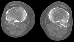 Angio-TC de MMII. Corte axial. Desplazamiento posterior de arteria poplítea izquierda (círculos).