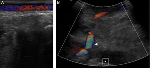 A y B) Eco-Doppler: control del bypass. A) Trayecto superficial de la VSI «in situ». B) Bypass permeable (punta de flecha). Cóndilo femoral (asterisco).