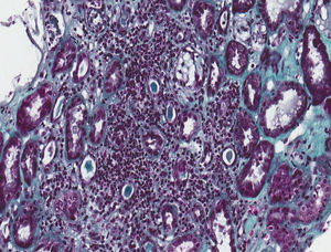 Nefritis túbulo-intersticial. Biopsia renal. La imagen histológica muestra un infiltrado inflamatorio linfocitario que afecta predominantemente al intersticio y cambios regenerativos del epitelio tubular (tricrómico de Masson, 20×).