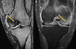 Imágenes de resonancia magnética: A) Situación al 10.° mes. Rodilla izquierda. Afectación de cóndilo interno. B) Situación al 12.° mes. Rodilla izquierda. Afectación de cóndilo externo.