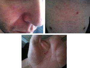Generalized macular and maculopapular skin rash.