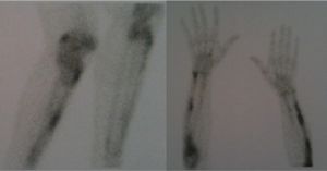 Bone scintigraphy extensive polyostotic uptake.