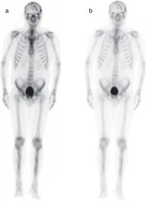 Scintigraphy at presentation (a) and at 6-month (b) blood pool phase.
