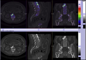 SPECT/CT: calcificación del ligamento vertebral común anterior y preservación de los espacios discales intervertebrales.
