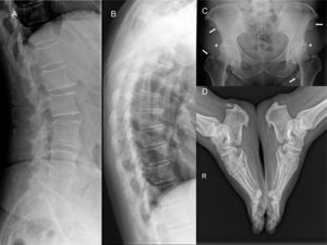 Estudio radiológico del caso 1. A y B. Proyecciones laterales de la columna dorsal y lumbar con signos de espondiloartrosis de predominio lumbar sin osificaciones del LVCA. C. Excrecencias óseas prominentes acetabulares con conservación del espacio articular (*) y múltiples osificaciones de entesis en las espinas ilíacas y los trocánteres (flechas). D. Excrecencias óseas prominentes en las entesis plantares y aquíleas.