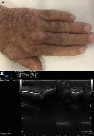A. Xantomas tendinosos en los tendones extensores de los dedos. B. Ecografía del mismo paciente, tendón extensor del tercer dedo: en un corte transversal y longitudinal se ve un tendón engrosado, de una ecotextura heterogénea.